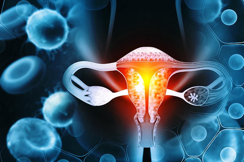 Niraparib maintenance yields favourable OS trend in patients with ovarian cancer