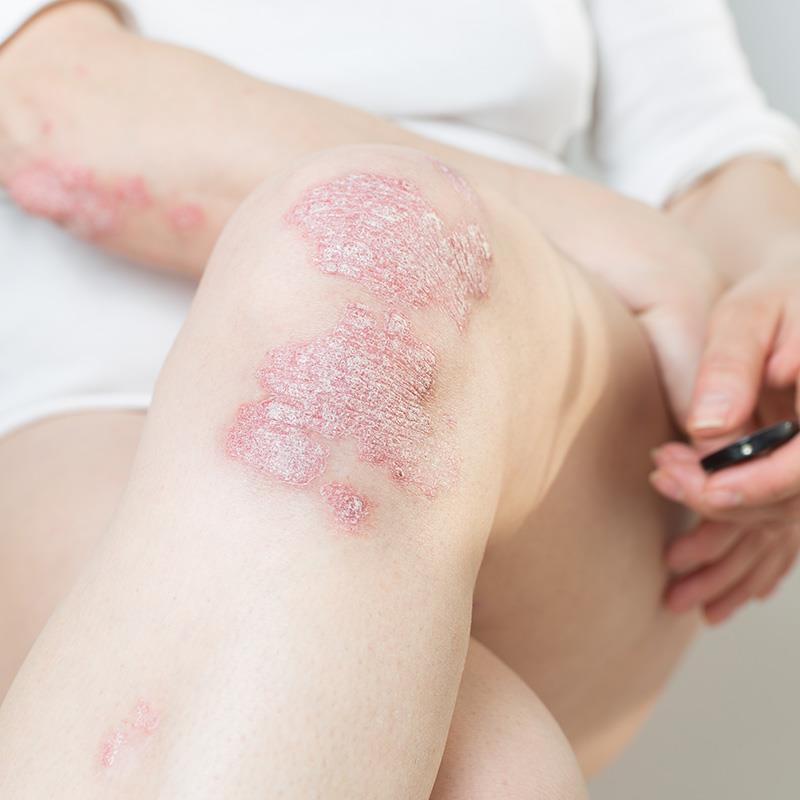 Deucravacitinib bests placebo, apremilast in moderate-to-severe plaque psoriasis