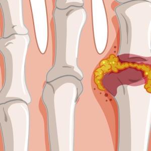 Management of Gout: Choosing an Alternative