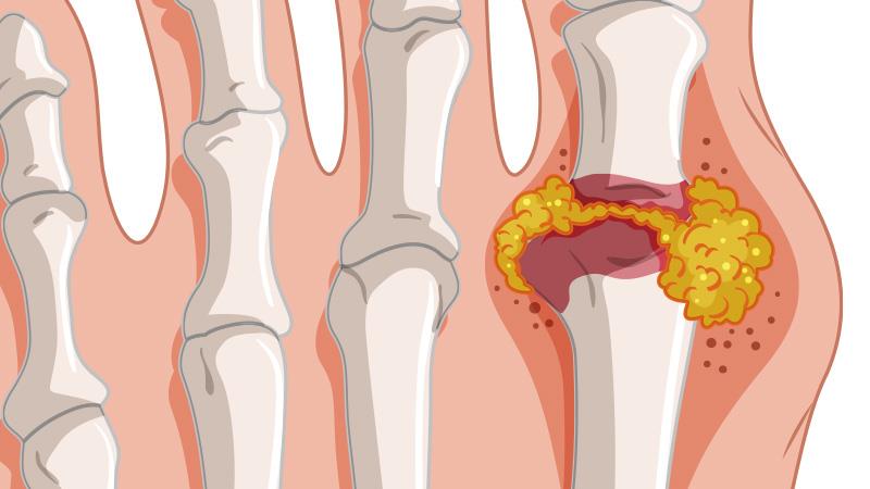 Management of Gout: Choosing an Alternative