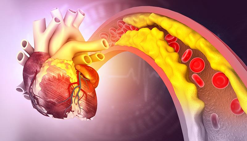 Obicetrapib cuts LDL-C in patients with HeFH