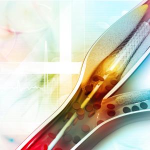 OCT- vs angiography-guided PCI for bifurcation lesions: Which is better?