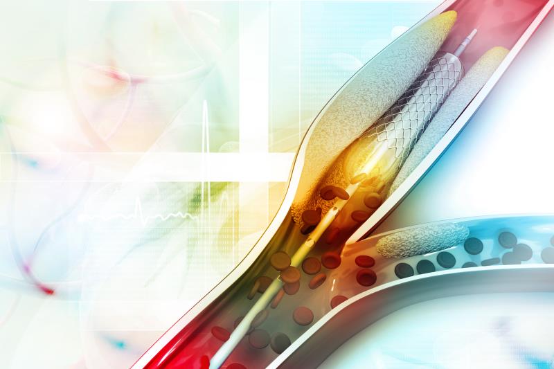 OCT- vs angiography-guided PCI for bifurcation lesions: Which is better?