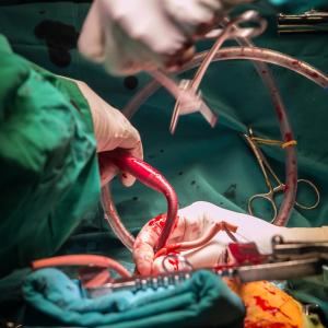 CABG outperforms PCI in diabetics with multivessel disease