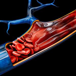 Extended anticoagulation benefits cancer patients with distal DVT