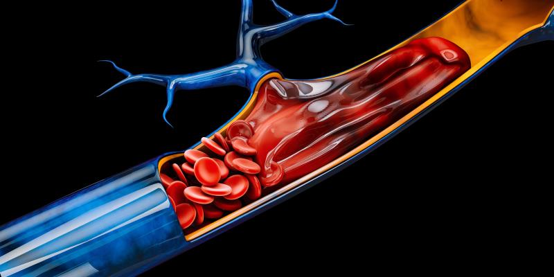 In cancer patients with isolated distal <a href="https://specialty.mims.com/venous%20thromboembolism%20-%20management/treatme