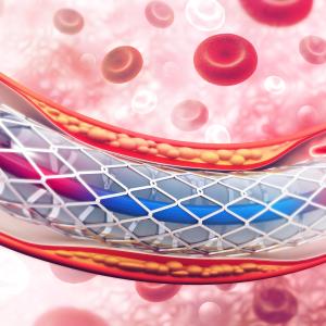 One-month DAPT sufficient after PCI?