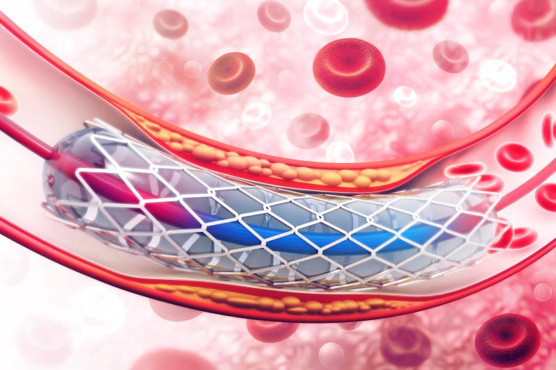 One-month DAPT sufficient after PCI?