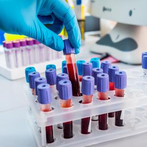 Circulating IL-17A predicts CVD in early RA