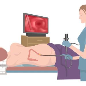 Colonoscopy intervals may be extended beyond 10 years for people at low CRC risk