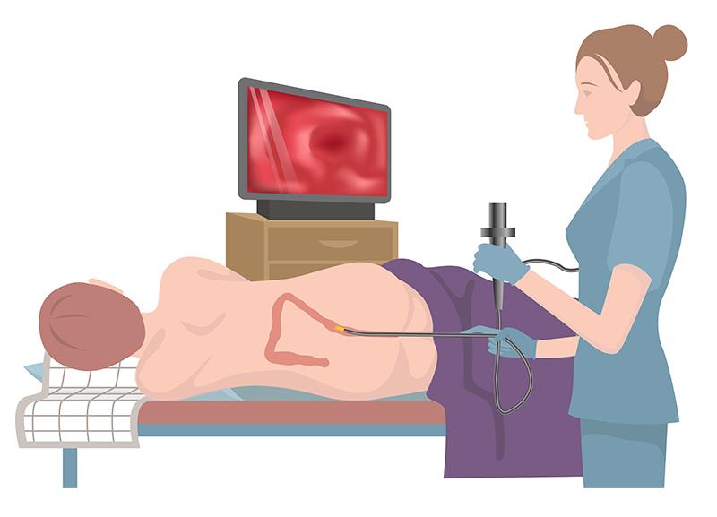 Colonoscopy intervals may be extended beyond 10 years for people at low CRC risk