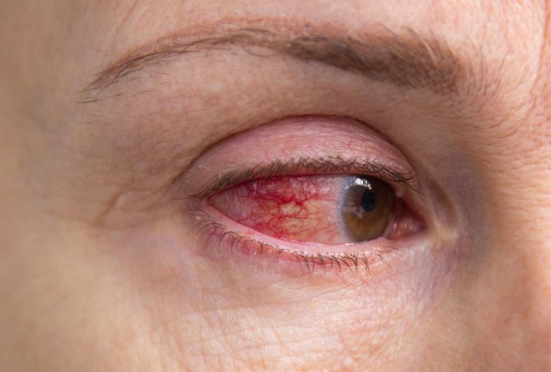 Novel cyclosporine formulation delivers in dry eye disease