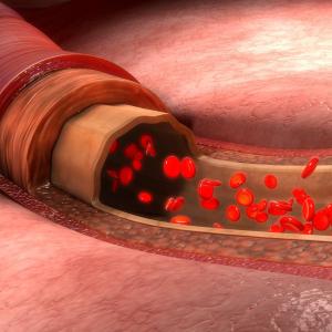 Antiplatelet plus anticoagulant therapy linked to better outcomes in COVID-19