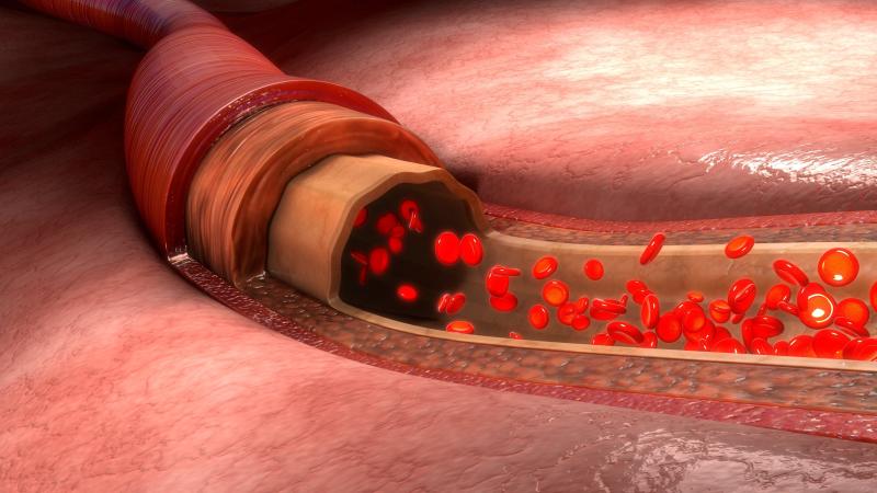 Antiplatelet plus anticoagulant therapy linked to better outcomes in COVID-19