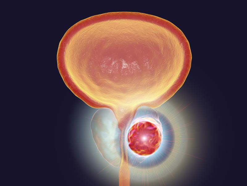 A 52-week course of intensified androgen-deprivation therapy (ADT) appears to extend prostate-specific antigen progression-fr