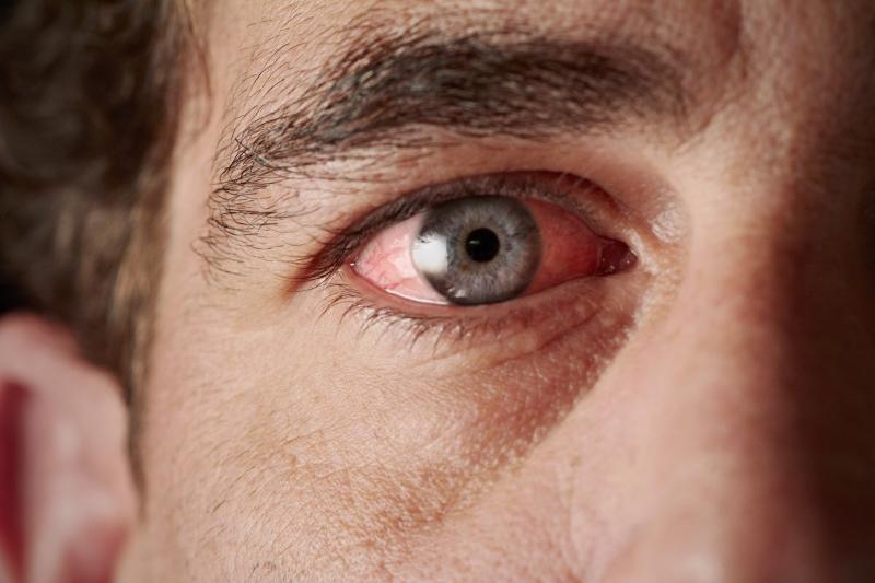 Noninfectious uveitis relapse lower with infliximab vs adalimumab