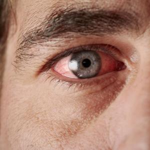 Noninfectious uveitis relapse lower with infliximab vs adalimumab