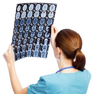 Anti-CD20 show promise in multiple sclerosis after alemtuzumab