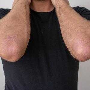 Oral roflumilast trims weight in patients with psoriasis