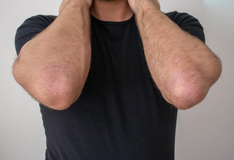 Oral roflumilast trims weight in patients with psoriasis