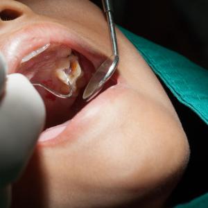 Localized periodontitis tied to proteinuria, kidney injury