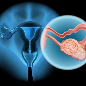 Trabectedin flops against advanced ovarian, uterine carcinosarcoma