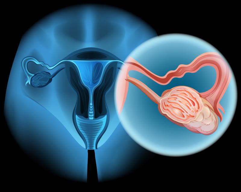 Trabectedin flops against advanced ovarian, uterine carcinosarcoma