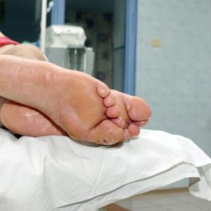 Complications more common in children with long-bone subperiosteal abscess