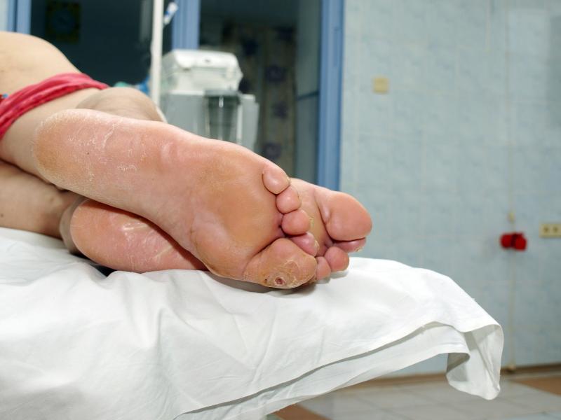 Complications more common in children with long-bone subperiosteal abscess