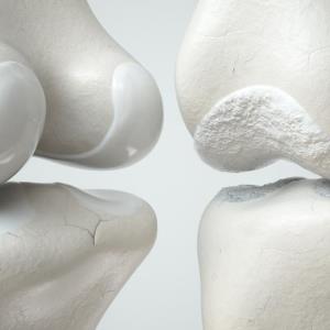 Can lithium reduce risk of osteoporosis in bipolar patients?