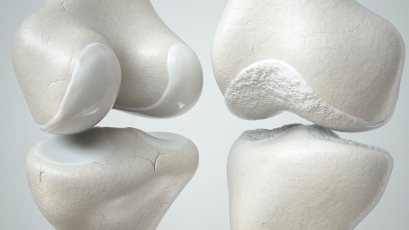 Can lithium reduce risk of osteoporosis in bipolar patients?