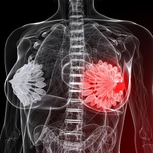 Fulvestrant–sapanisertib combo shows modest benefit in advanced, metastatic breast cancer