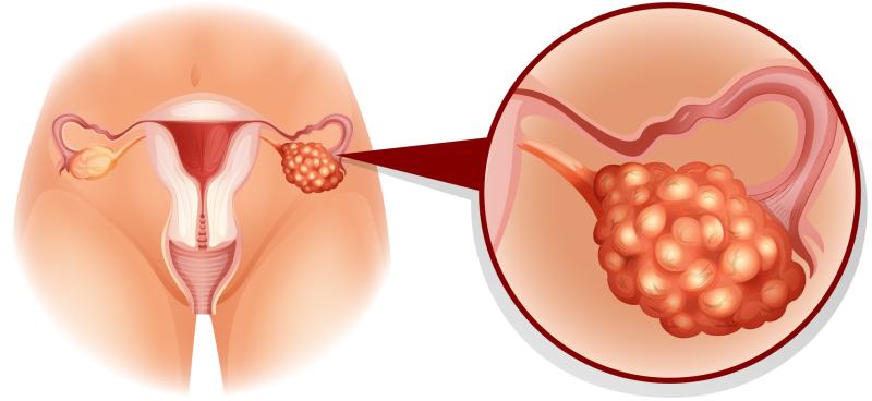 Fuzuloparib prolongs PFS in patients with recurrent ovarian cancer