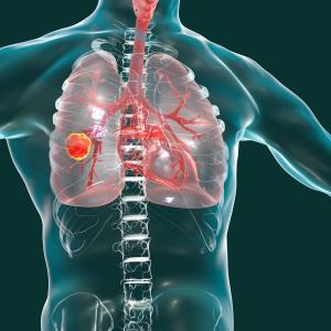 ‘PACIFIC regimen’ shows long-term survival benefit with durvalumab in advanced NSCLC