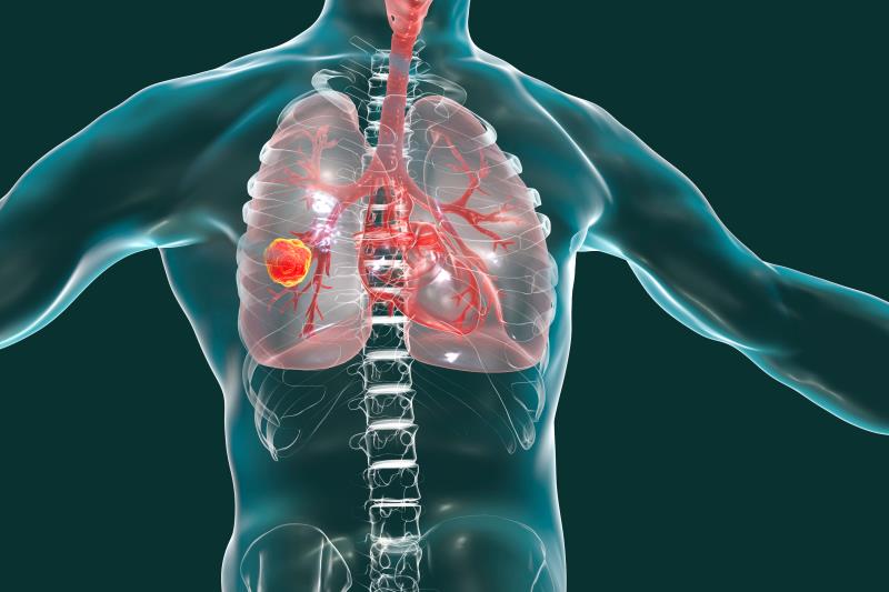 ‘PACIFIC regimen’ shows long-term survival benefit with durvalumab in advanced NSCLC