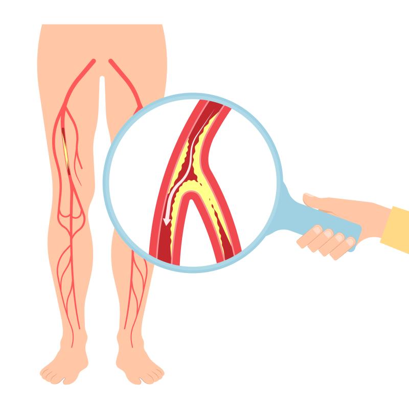 Paclitaxel-coated devices in femoropopliteal artery revascularization: Mortality risk fears unfounded?