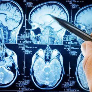 Mood, physical function tied to HRQoL in patients with brain metastases