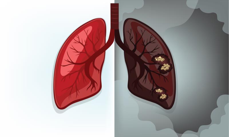 Pembrolizumab-based regimen continues to show favourable signals for ES-SCLC