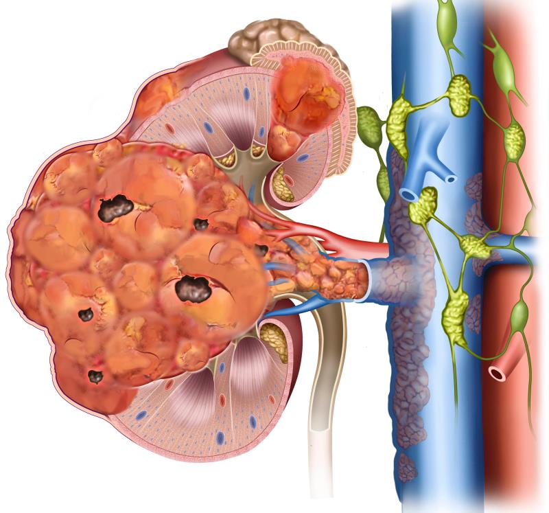 Pembrolizumab + axitinib benefit sustained at 24 months for advanced RCC