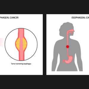 Pembrolizumab delivers long-term survival benefits in advanced esophageal cancer