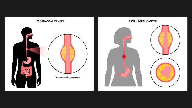 Pembrolizumab delivers long-term survival benefits in advanced esophageal cancer