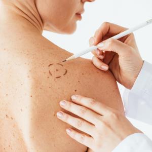 AI as good as experts at detecting melanomas