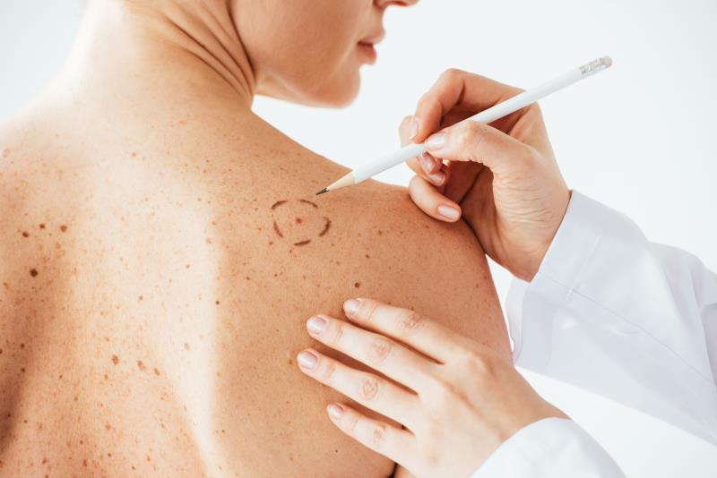 AI as good as experts at detecting melanomas