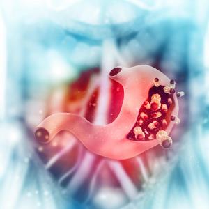 Ramucirumab–paclitaxel combo works better against HER2-positive vs -negative gastric cancers