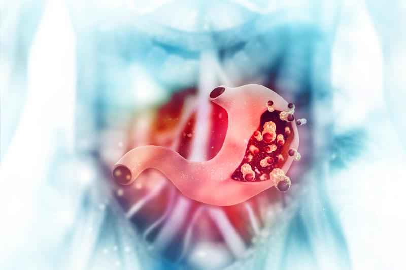 Pembrolizumab + SOX may benefit stomach cancer patients