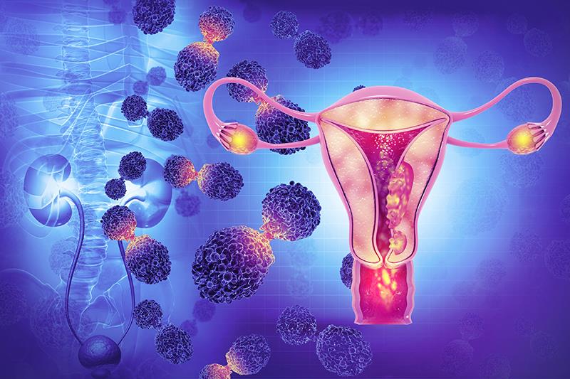 Pembrolizumab plus chemo ups survival in advanced endometrial cancer across MMR subgroups