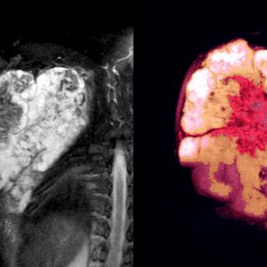 Pazopanib confers survival benefits in advanced soft tissue sarcoma