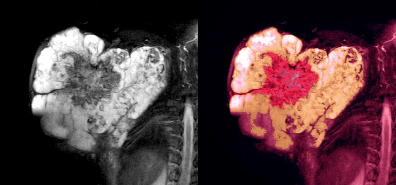 Pazopanib confers survival benefits in advanced soft tissue sarcoma