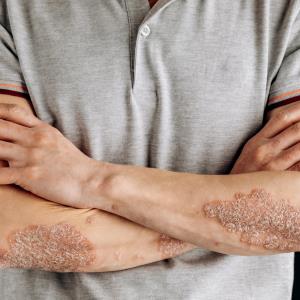 Ustekinumab biosimilar shows clinical similarity to reference drug for plaque psoriasis