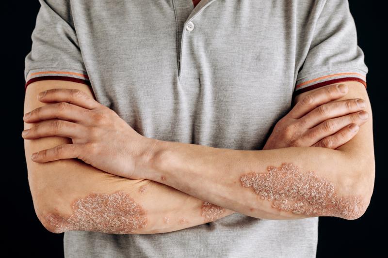 Ustekinumab biosimilar shows clinical similarity to reference drug for plaque psoriasis